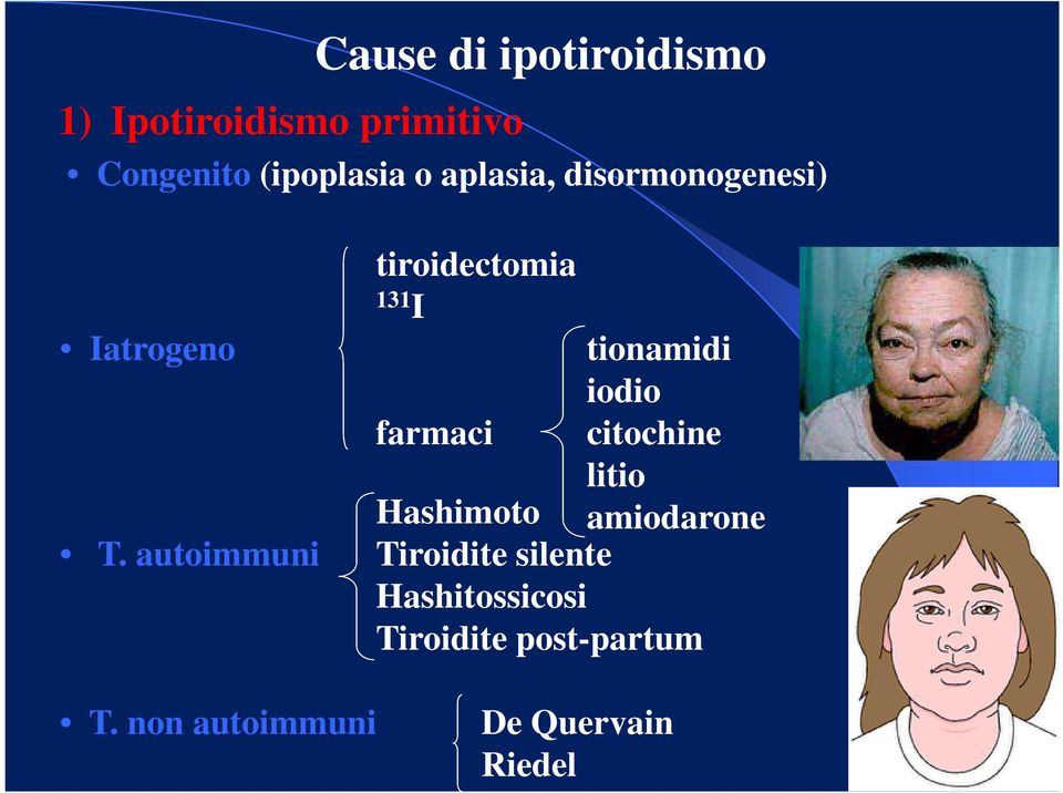 autoimmuni tiroidectomia 131 I tionamidi iodio farmaci citochine litio