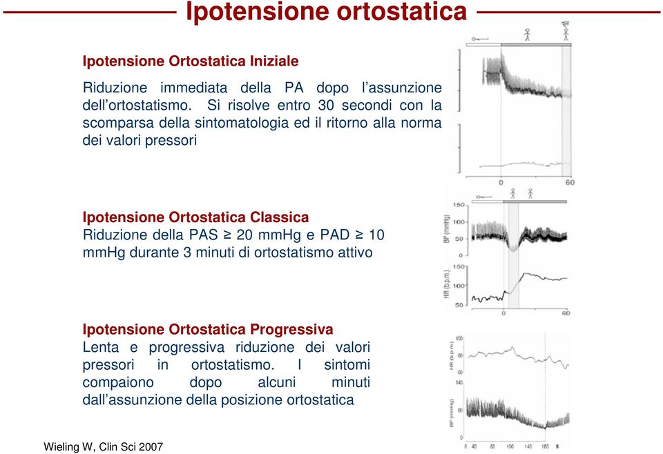 Classica Riduzione della PAS 20 mmhg e PAD 10 mmhg durante 3 minuti di ortostatismo attivo Ipotensione Ortostatica Progressiva Lenta e