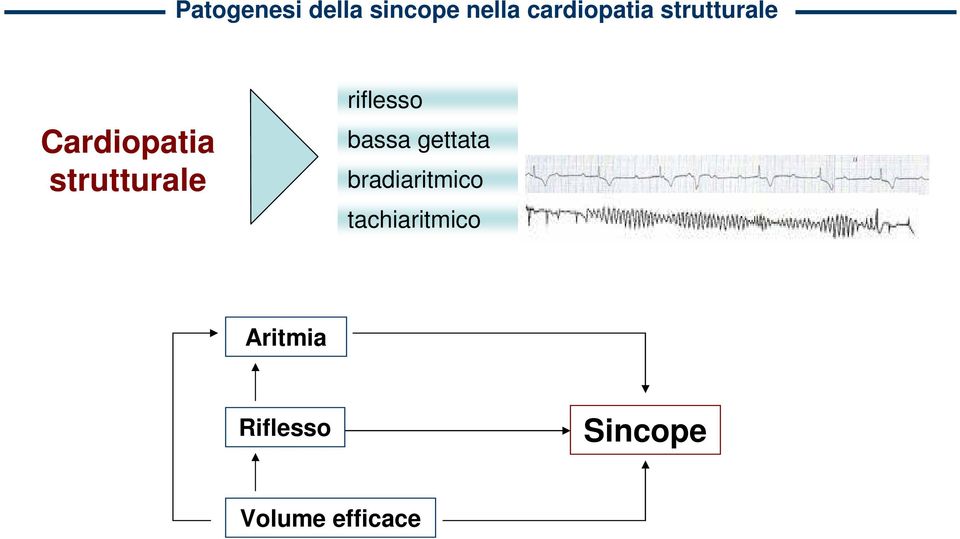 riflesso bassa gettata bradiaritmico