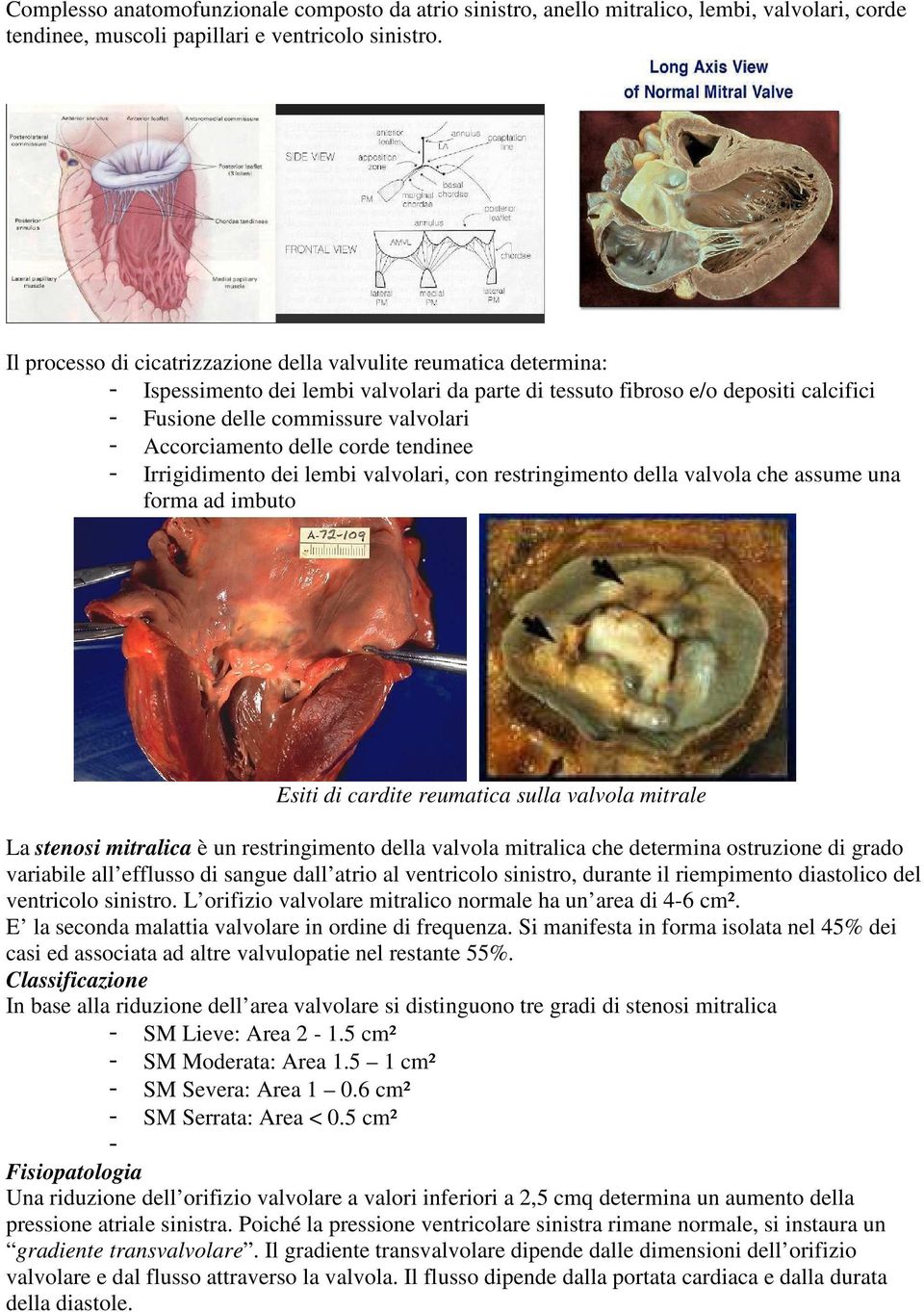 Accorciamento delle corde tendinee - Irrigidimento dei lembi valvolari, con restringimento della valvola che assume una forma ad imbuto Esiti di cardite reumatica sulla valvola mitrale La stenosi