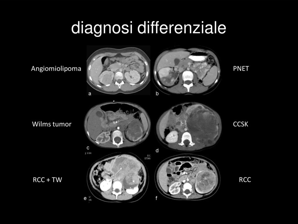 Angiomiolipoma