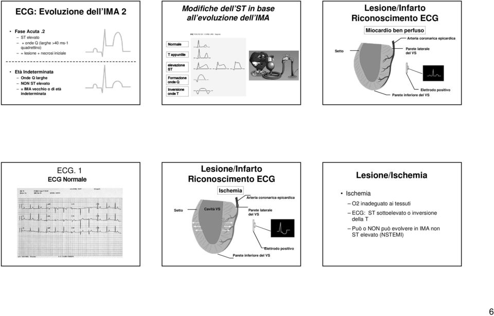 Indeterminata Onde Q larghe NON ST elevato = IMA vecchio o di età indeterminata elevazione ST Formazione onde Q Inversione onde T Elettrodo positivo Parete inferiore del VS.