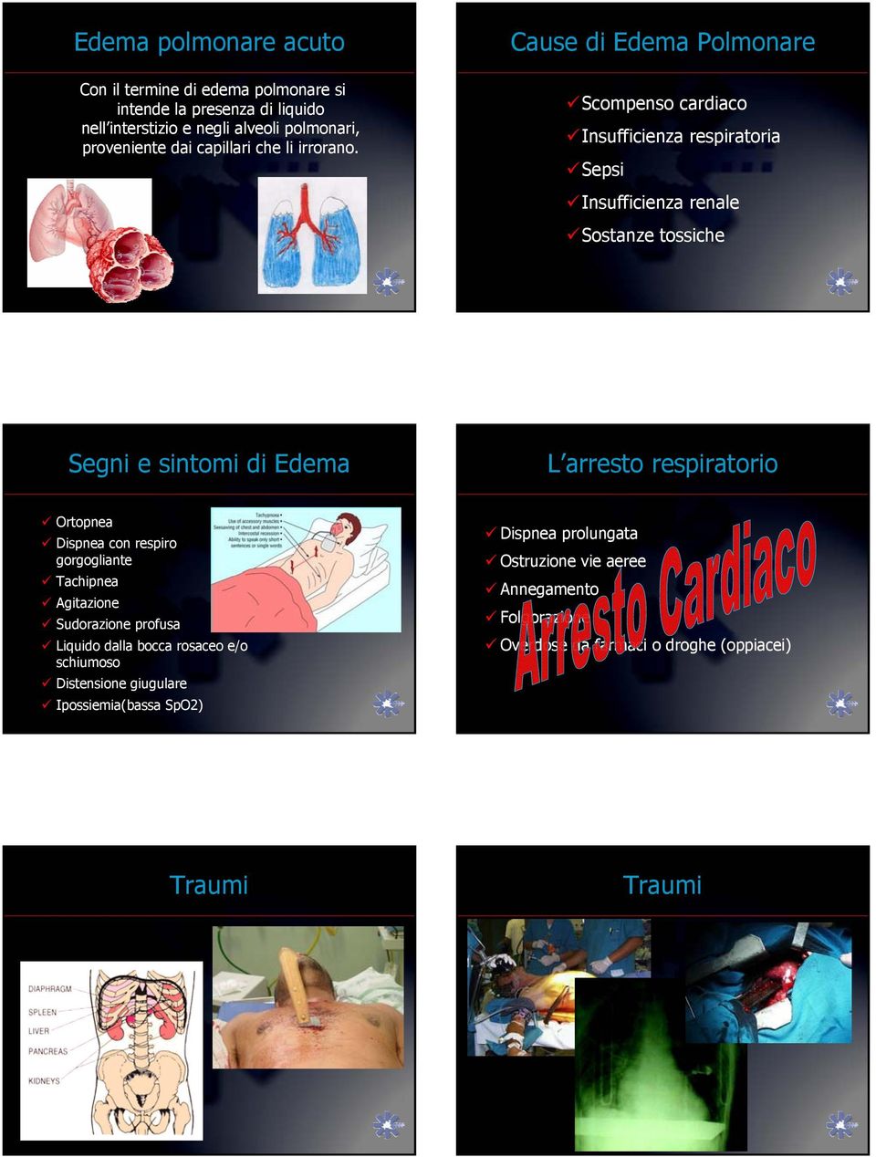 Cause di Edema Polmonare Scompenso cardiaco Insufficienza respiratoria Sepsi Insufficienza renale Sostanze tossiche Segni e sintomi di Edema L arresto