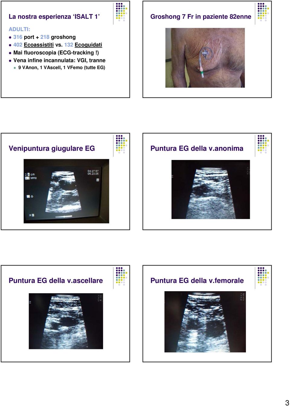 ) Vena infine incannulata: VGI, tranne 9 VAnon, 1 VAscell, 1 VFemo (tutte EG)