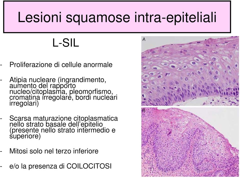 nucleari irregolari) - Scarsa maturazione citoplasmatica nello strato basale dell epitelio