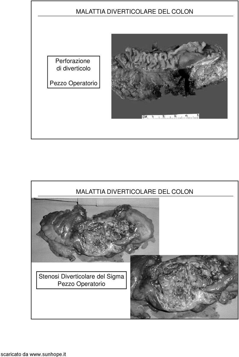 Operatorio  Stenosi Diverticolare del