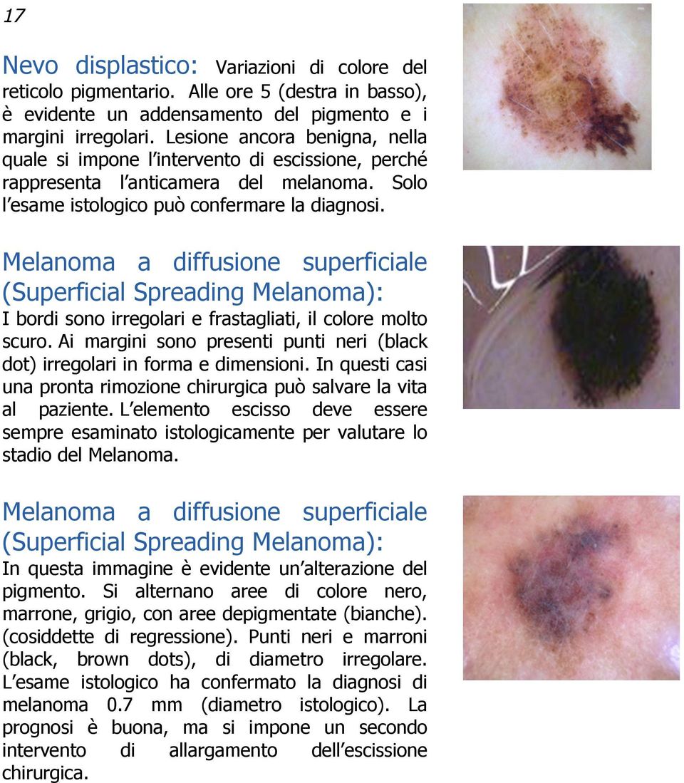 Melanoma a diffusione superficiale (Superficial Spreading Melanoma): I bordi sono irregolari e frastagliati, il colore molto scuro.
