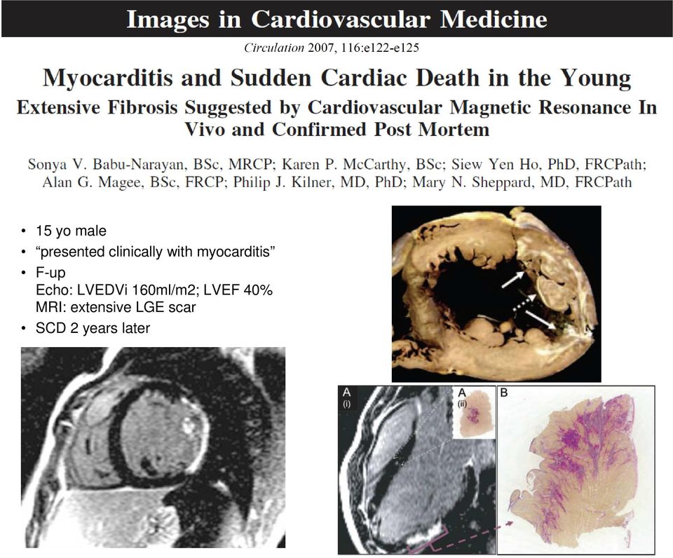 LVEDVi 160ml/m2; LVEF 40% MRI: