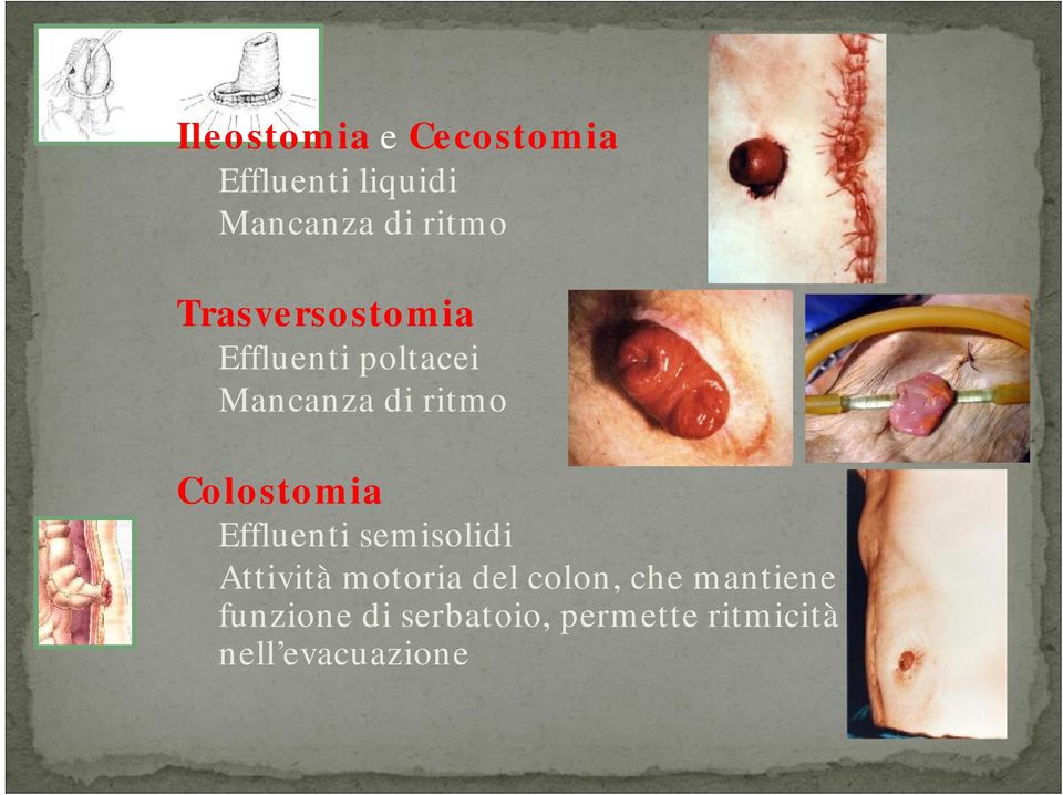 Colostomia Effluenti semisolidi Attività motoria del colon,