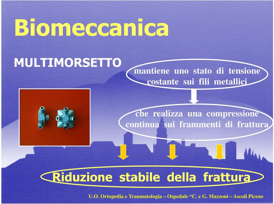 continua sui frammenti di frattura Riduzione stabile della