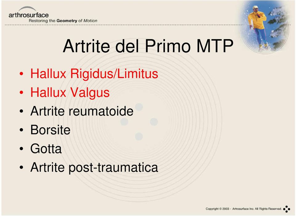 Valgus Artrite reumatoide