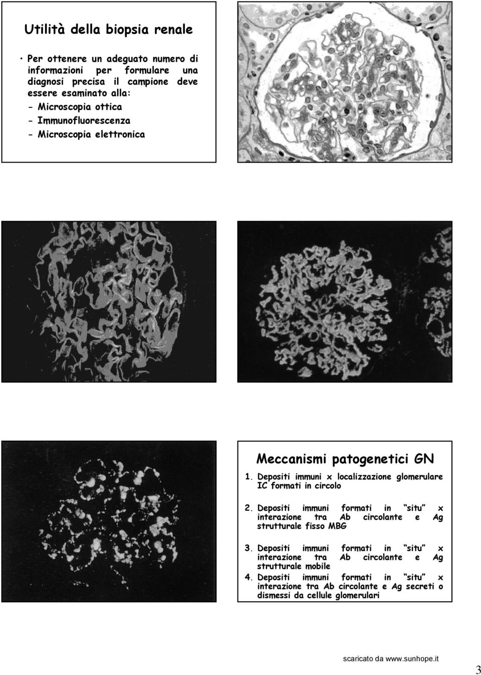 Depositi immuni x localizzazione glomerulare IC formati in circolo 2.