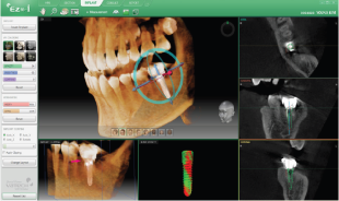 Struttura radicolare Lesioni Denti inclusi SIMULAZIONE IMPLANTARE 3 CLICK 3Non piu complesse misurazioni preventive o posizionamenti complessi.
