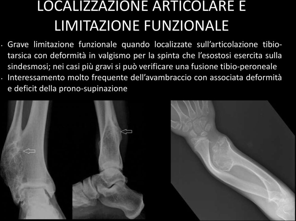 esostosi esercita sulla sindesmosi; nei casi più gravi si può verificare una fusione