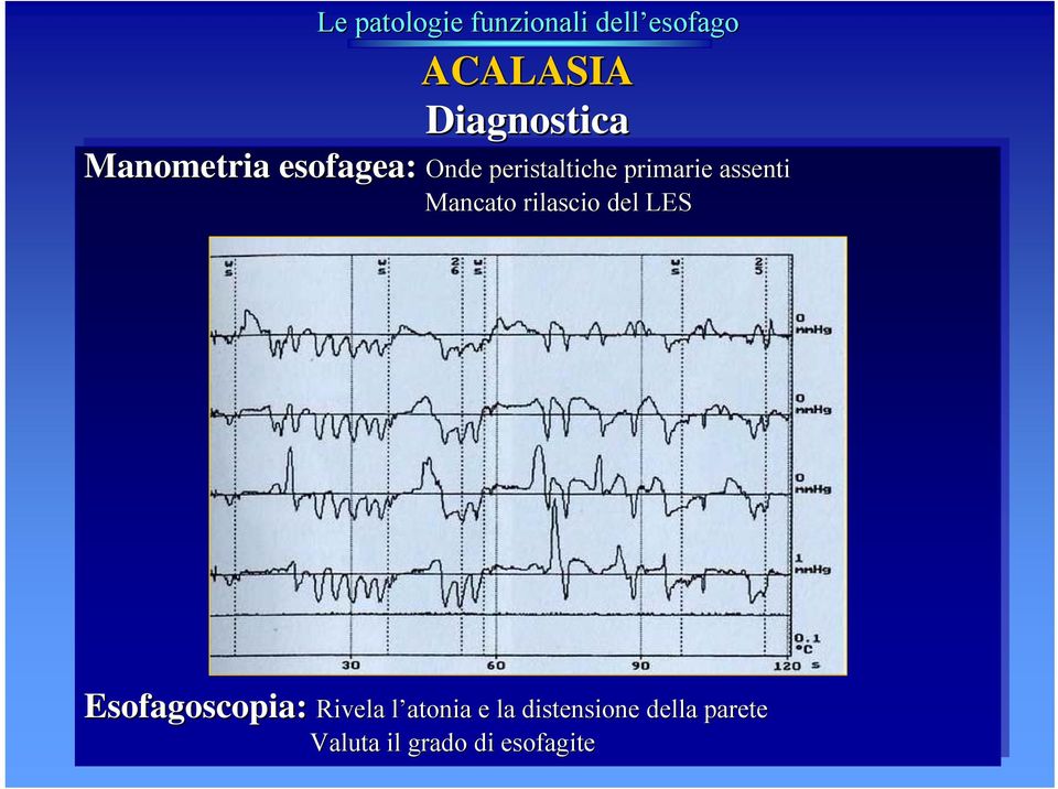 Mancato rilascio del LES Esofagoscopia: Rivela l Rivela l