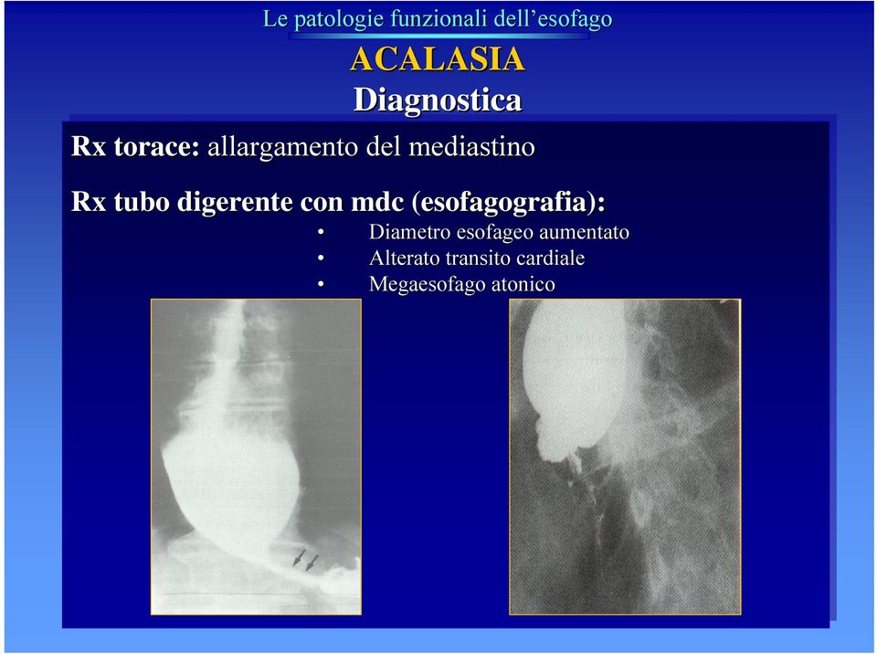 digerente con mdc (grafia): Diametro esofageo