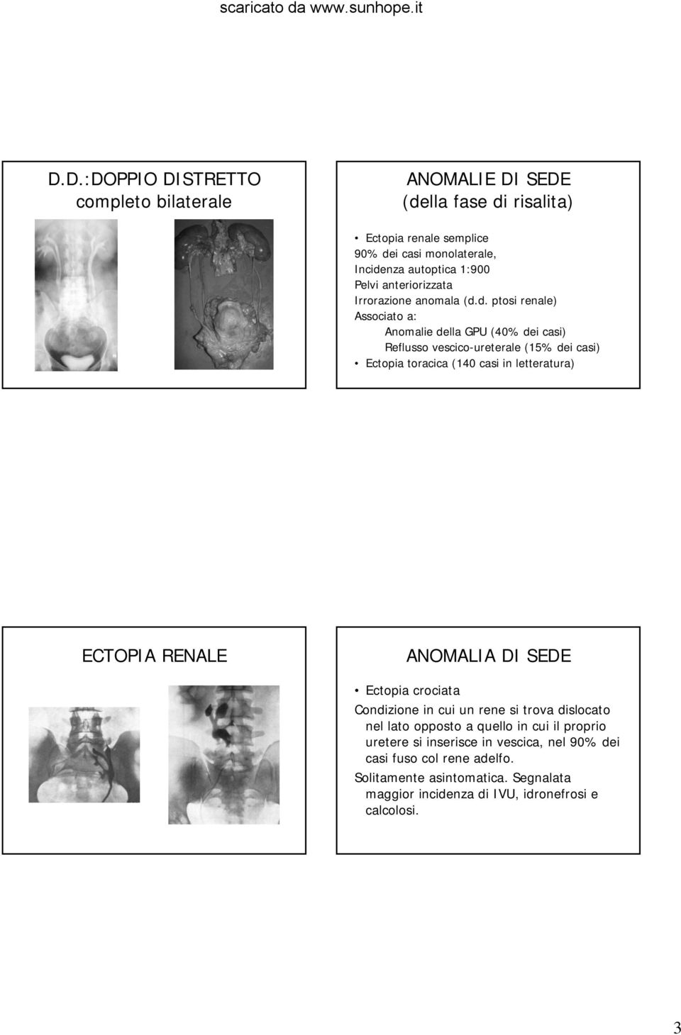 d. ptosi renale) Associato a: Anomalie della GPU (40% dei casi) Reflusso vescico-ureterale (15% dei casi) Ectopia toracica (140 casi in letteratura) ECTOPIA