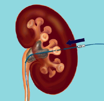 Le possibili principali complicanze della PNL sono rappresentate da: - sanguinamento intraoperatorio severo può richiedere an la sospensione dell intervento chirurgico o richiedere una conversione in