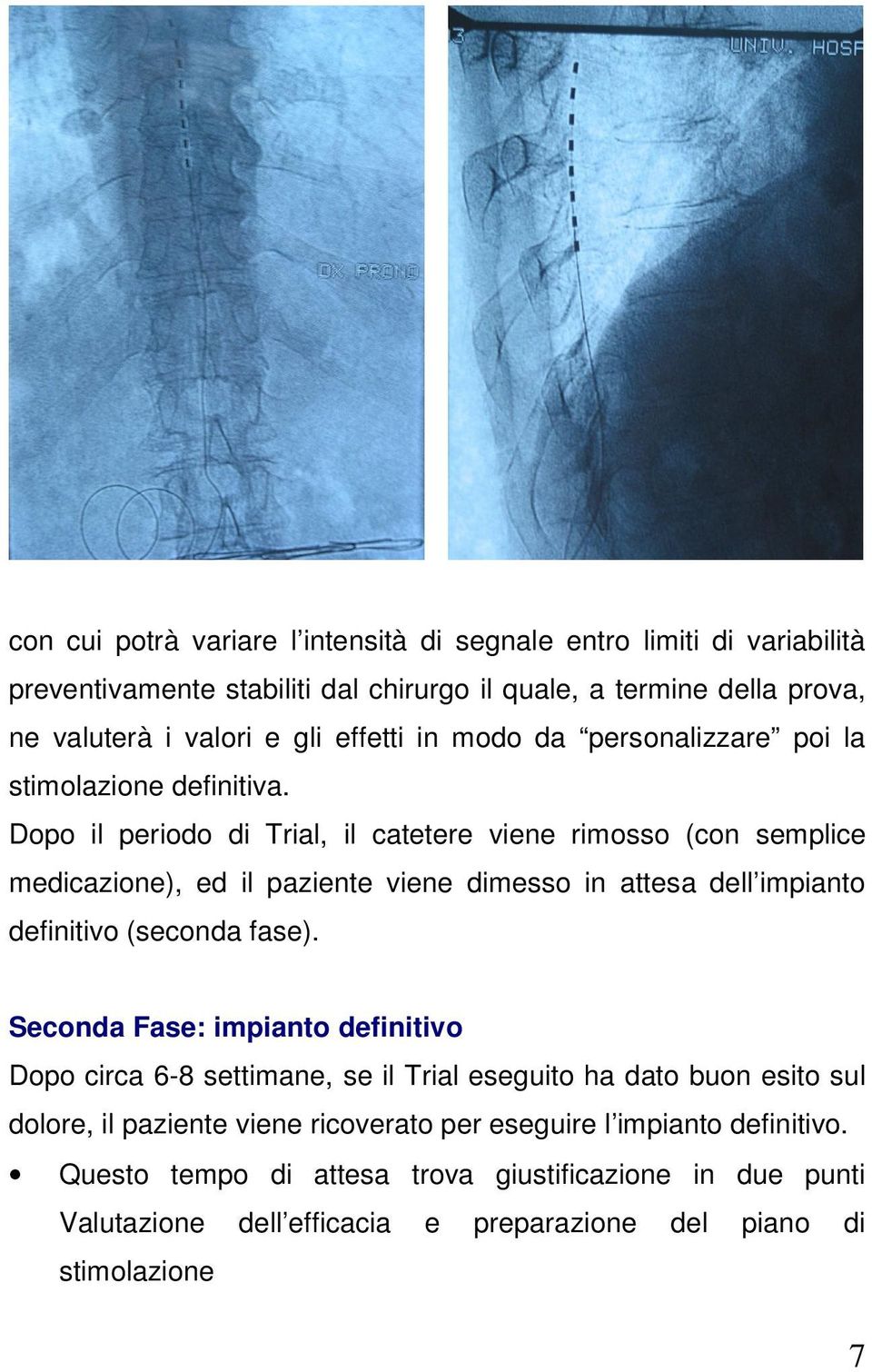 Dopo il periodo di Trial, il catetere viene rimosso (con semplice medicazione), ed il paziente viene dimesso in attesa dell impianto definitivo (seconda fase).