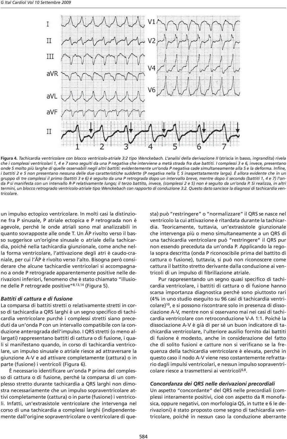 I complessi 3 e 6, invece, presentano onde S molto più larghe di quelle osservabili negli altri battiti: evidentemente un onda P negativa cade simultaneamente alla S e la deforma.