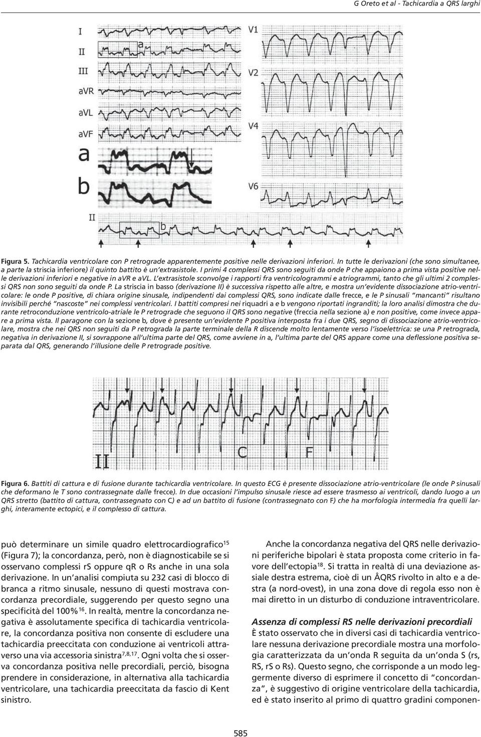 I primi 4 complessi QRS sono seguiti da onde P che appaiono a prima vista positive nelle derivazioni inferiori e negative in avr e avl.