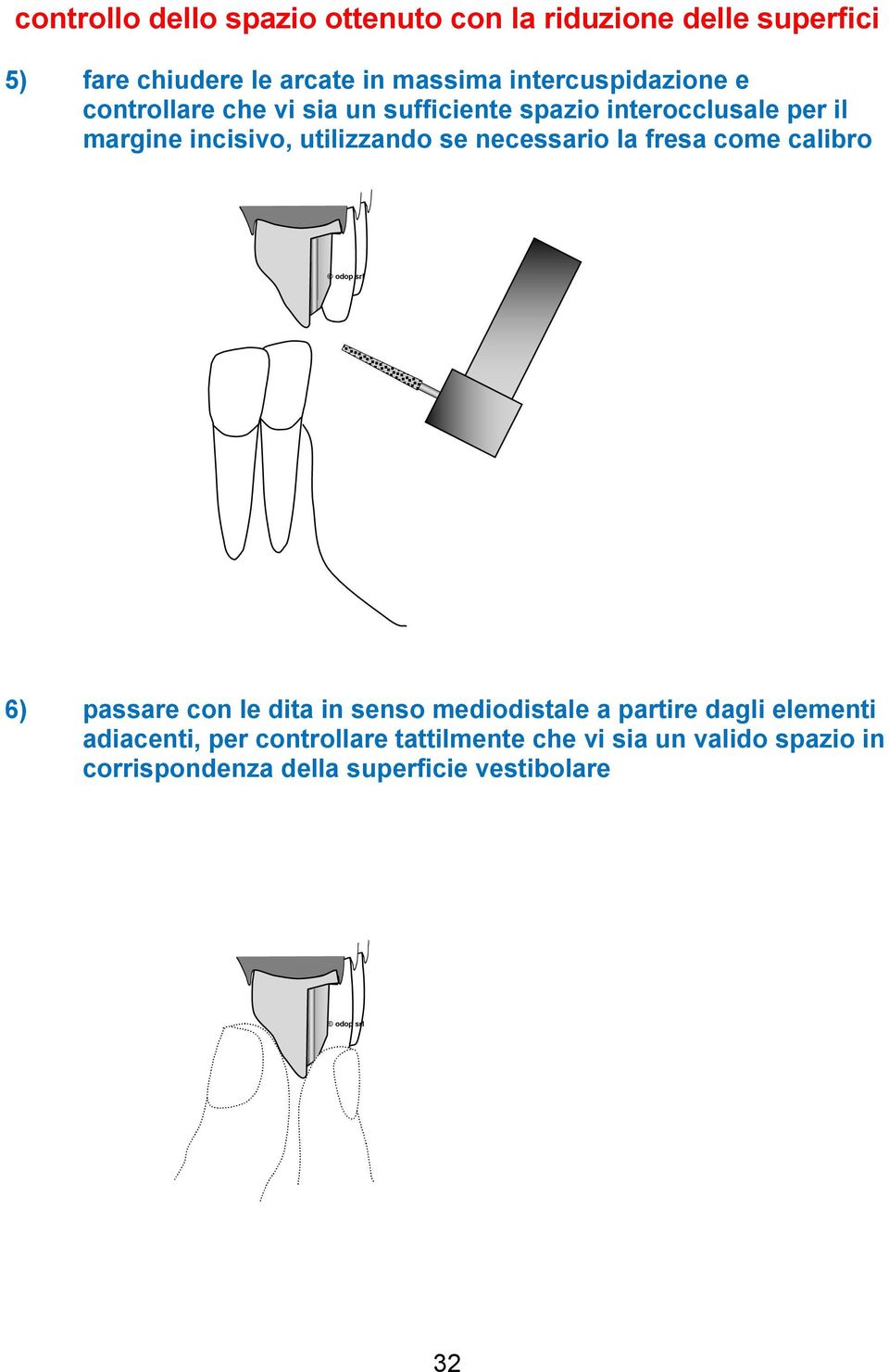 utilizzando se necessario la fresa come calibro 6) passare con le dita in senso mediodistale a partire dagli