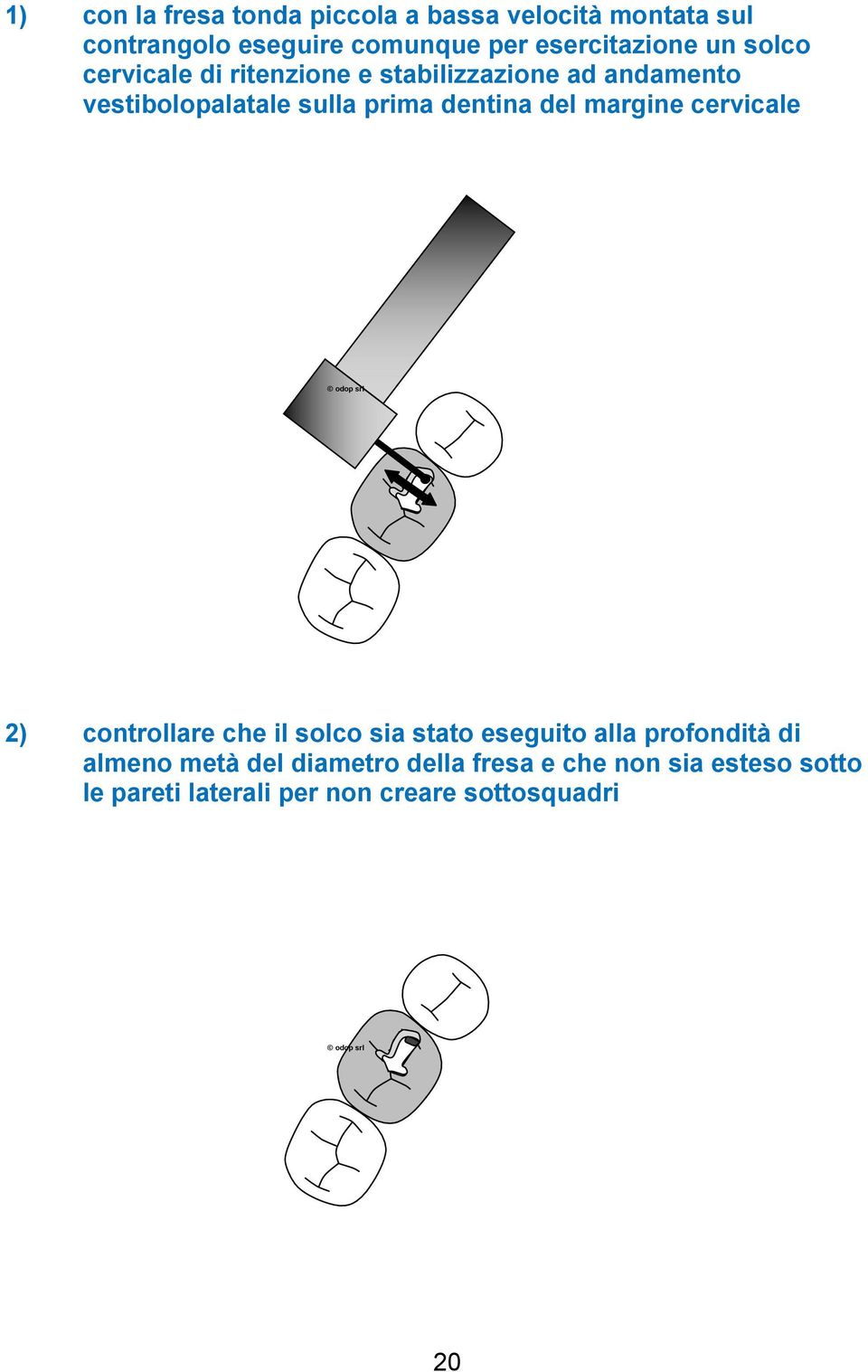 prima dentina del margine cervicale 2) controllare che il solco sia stato eseguito alla profondità di