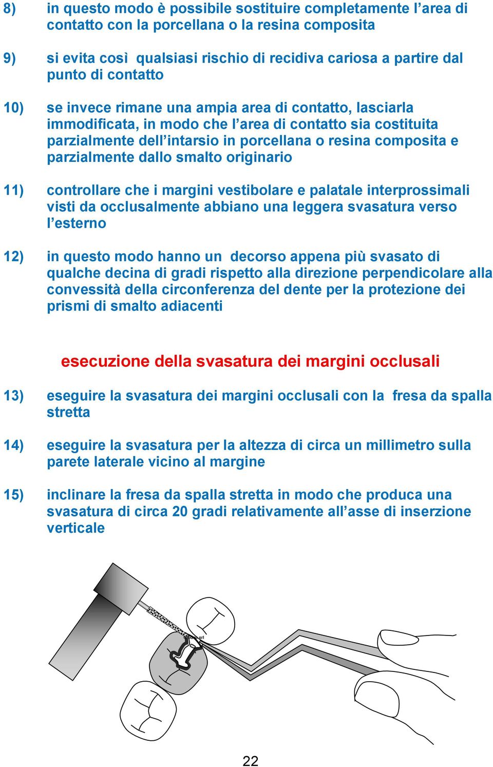 parzialmente dallo smalto originario 11) controllare che i margini vestibolare e palatale interprossimali visti da occlusalmente abbiano una leggera svasatura verso l esterno 12) in questo modo hanno