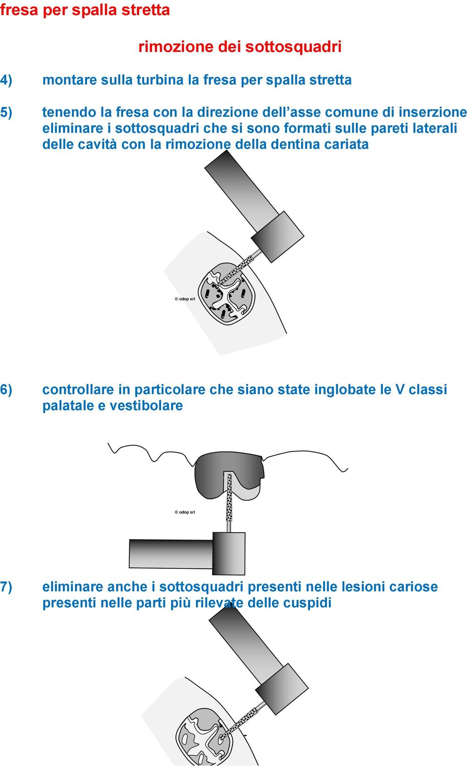 cavità con la rimozione della dentina cariata 6) controllare in particolare che siano state inglobate le V classi palatale e