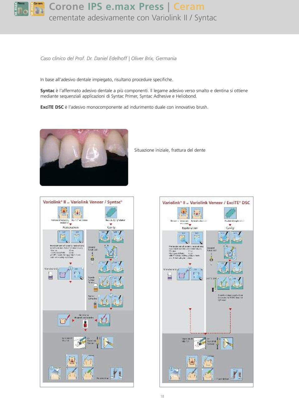Syntac è l affermato adesivo dentale a più componenti.