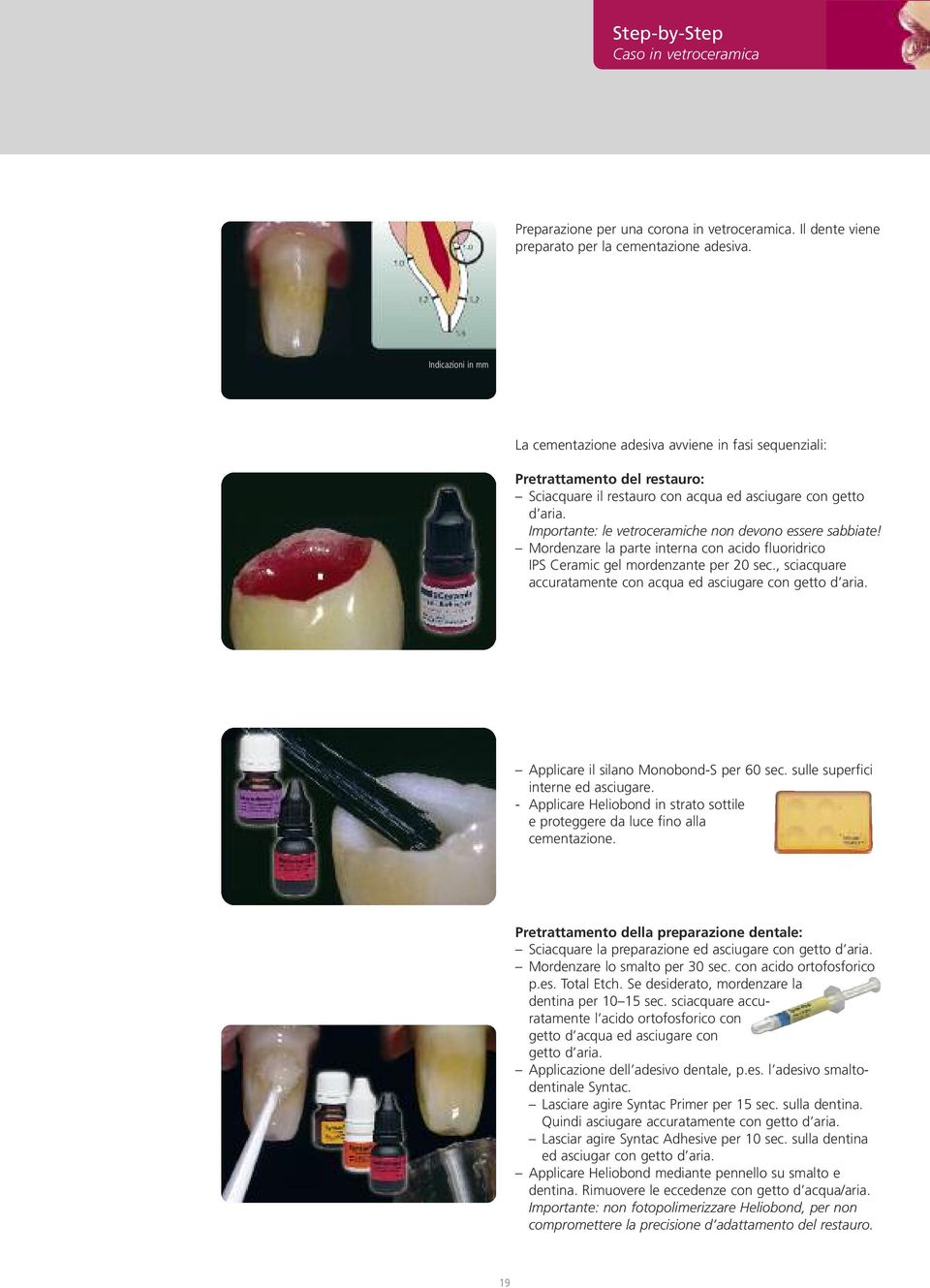 Importante: le vetroceramiche non devono essere sabbiate! Mordenzare la parte interna con acido fluoridrico IPS Ceramic gel mordenzante per 20 sec.