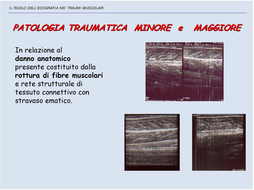 costituito dalla rottura di fibre muscolari e