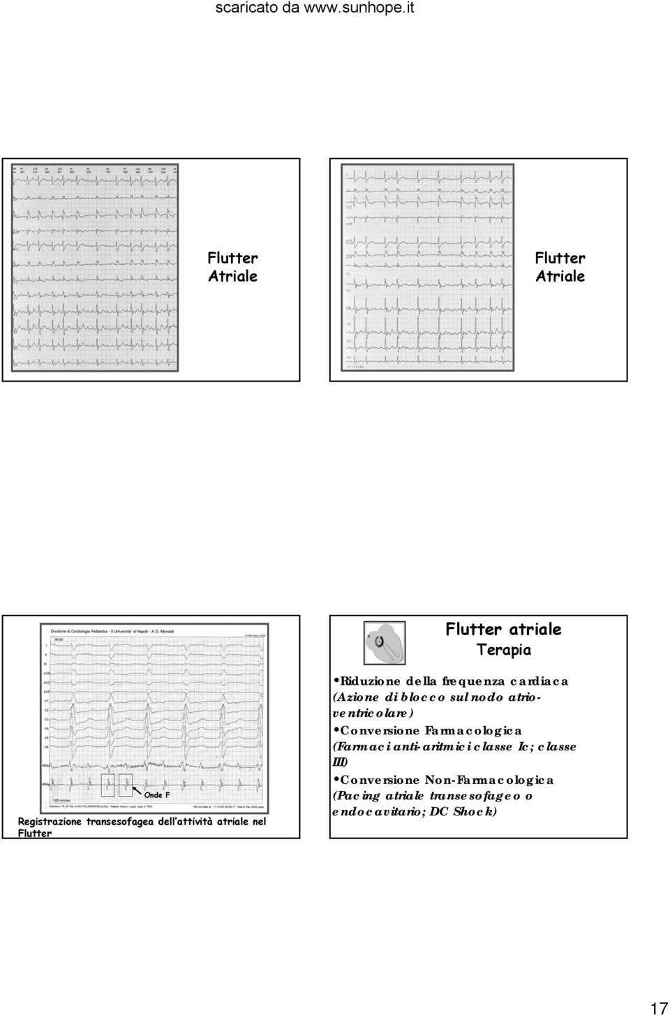 nodo atrioventricolare) Conversione Farmacologica (Farmaci anti-aritmici classe Ic; classe