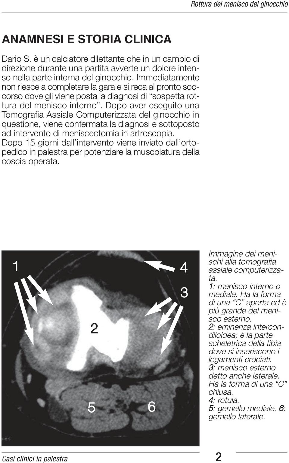 Dopo aver eseguito una Tomografia Assiale Computerizzata del ginocchio in questione, viene confermata la diagnosi e sottoposto ad intervento di meniscectomia in artroscopia.