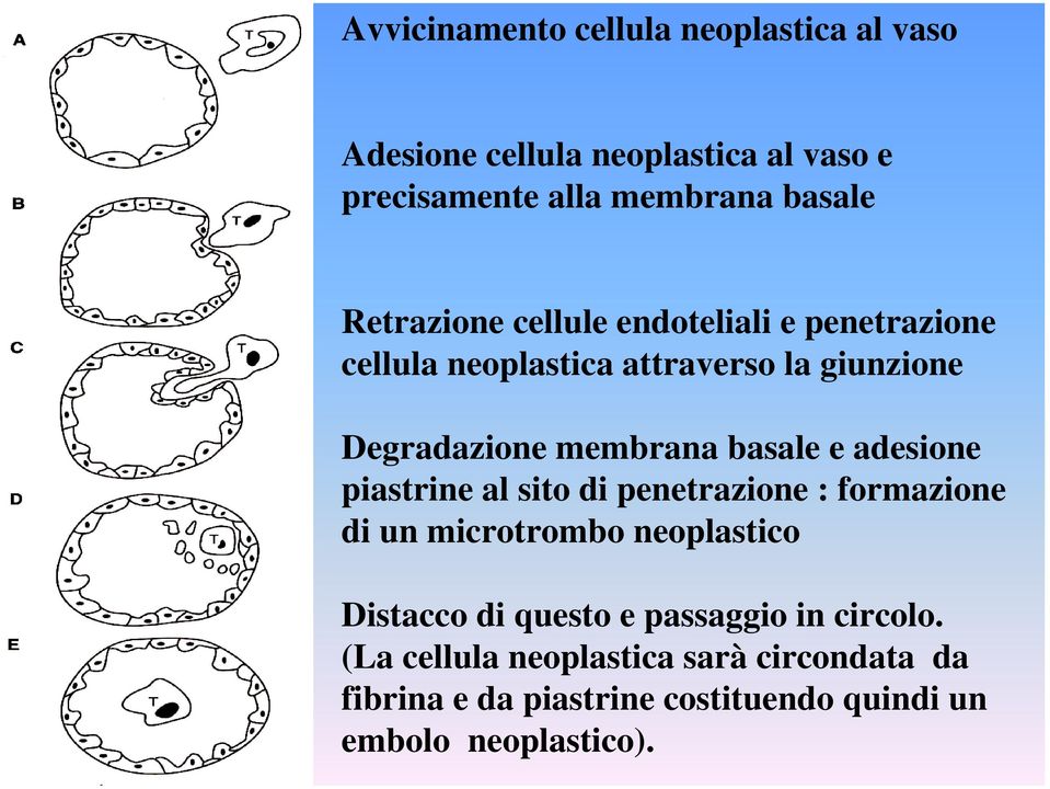 e adesione piastrine al sito di penetrazione : formazione di un microtrombo neoplastico Distacco di questo e passaggio