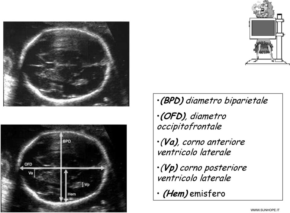 anteriore ventricolo laterale (Vp)