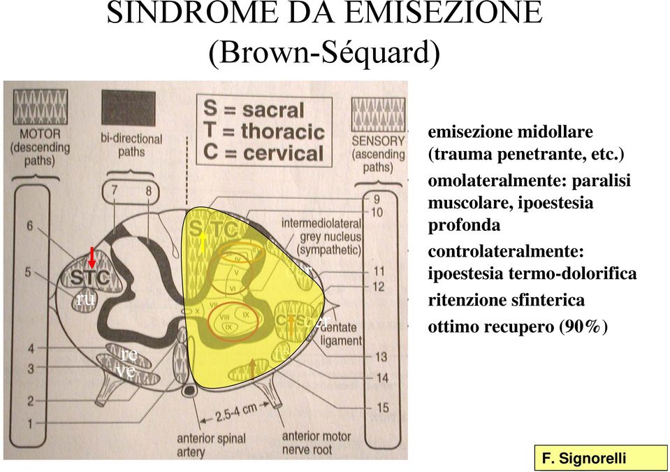 ) omolateralmente: paralisi muscolare, ipoestesia profonda