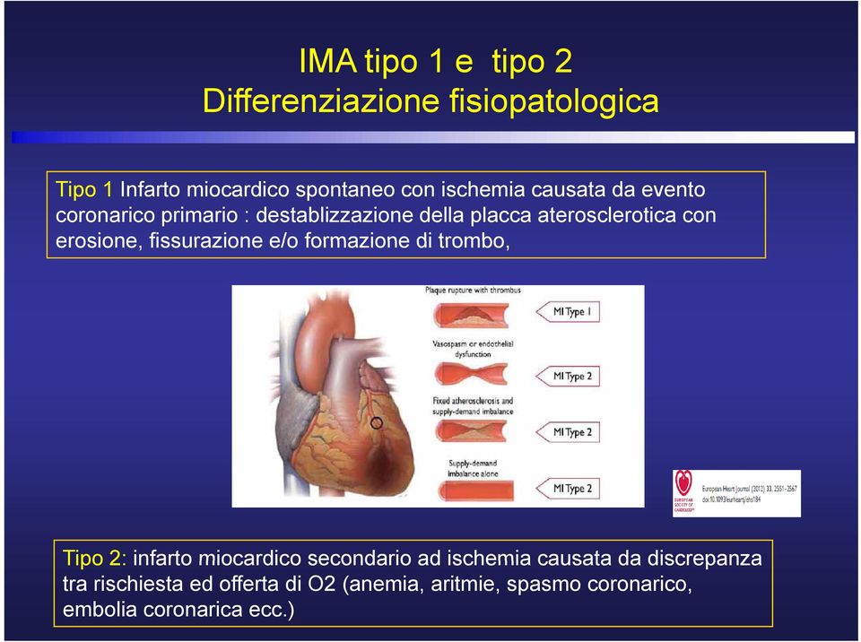 trombo, Tipo 2: infarto miocardico secondario ad ischemia causata da discrepanza Tipo 2: infarto miocardico secondario