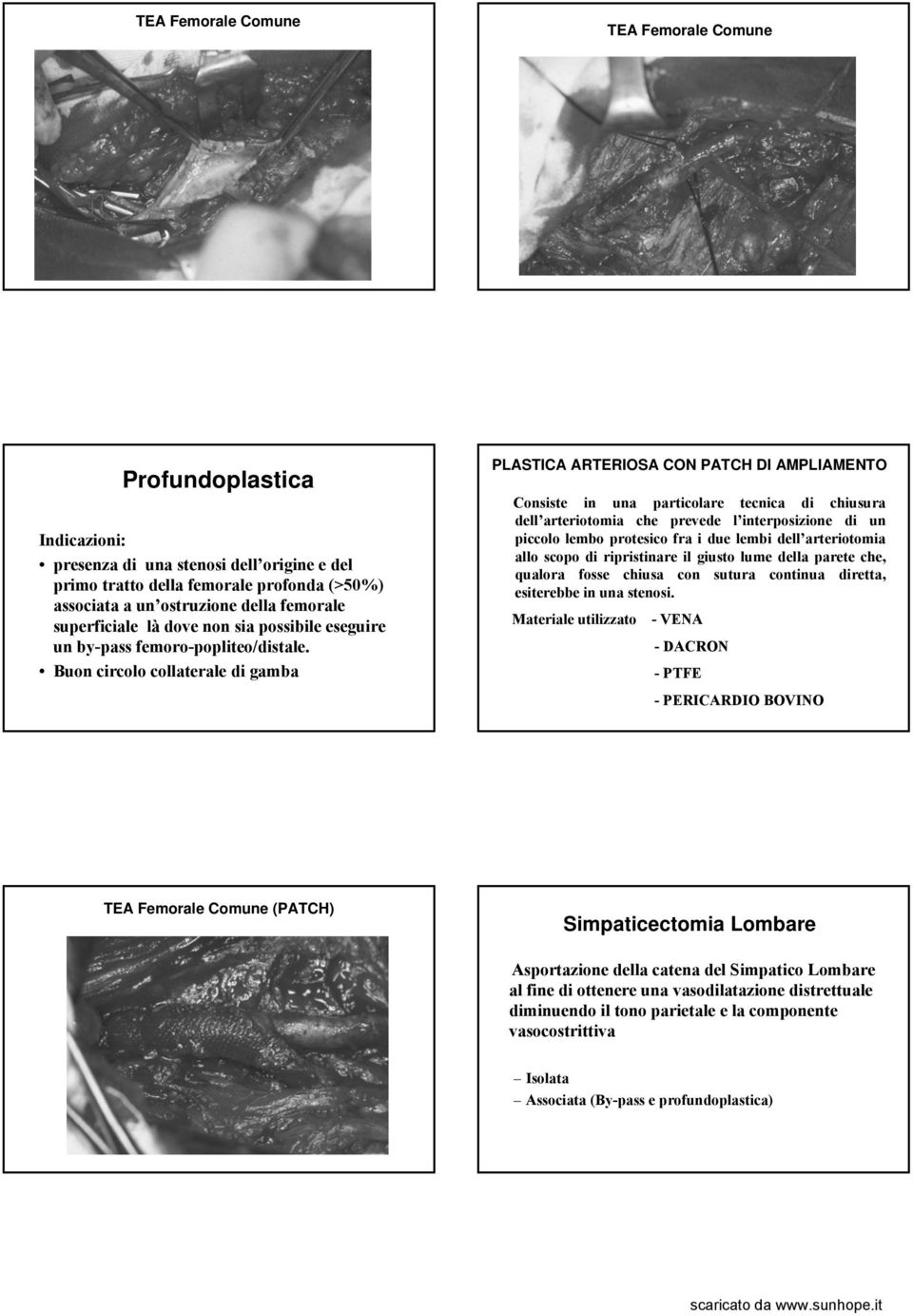 Buon circolo collaterale di gamba PLASTICA ARTERIOSA CON PATCH DI AMPLIAMENTO Consiste in una particolare tecnica di chiusura dell arteriotomia che prevede l interposizione di un piccolo lembo