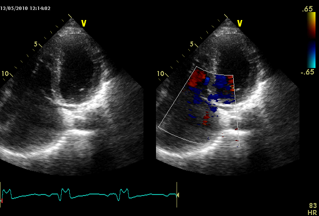 aortico ed aorta ascendente Appiattimento del setto IV da