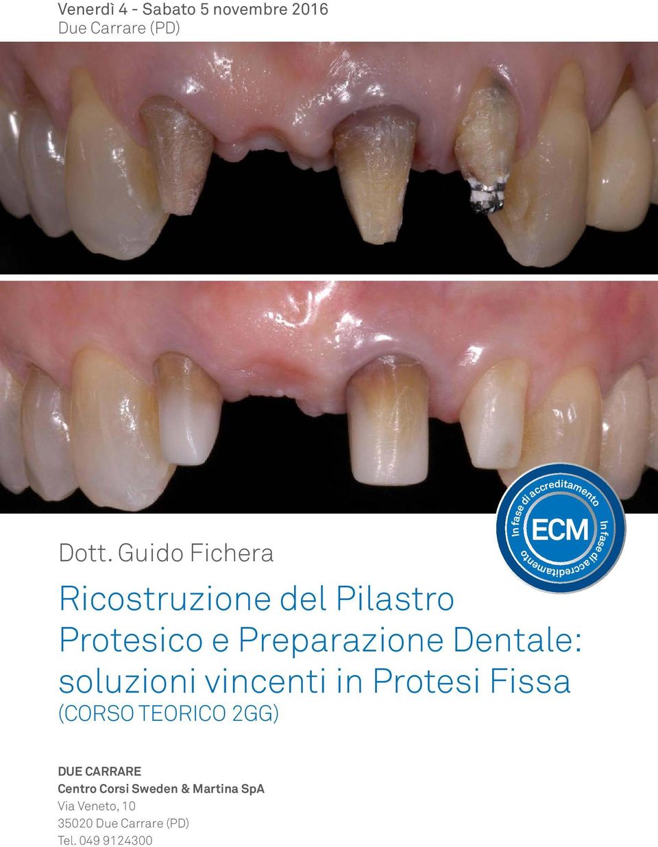 Guido Fichera Ricostruzione del Pilastro Protesico e Preparazione Dentale: soluzioni
