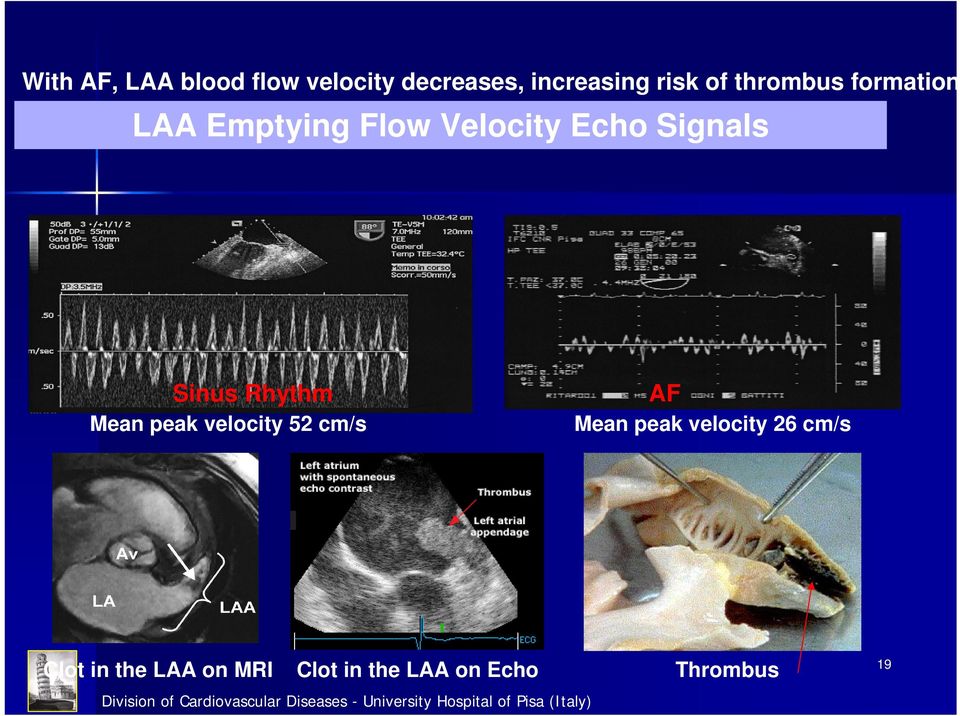 Velocity Echo Signals Sinus Rhythm Mean peak velocity 52 cm/s AF Mean