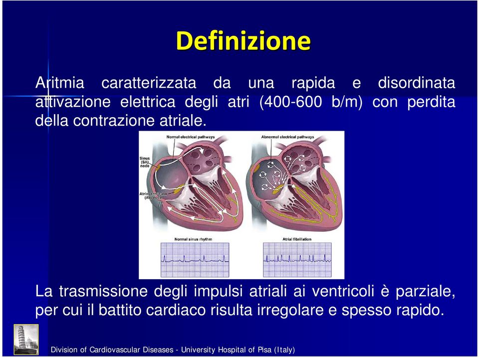 contrazione atriale.