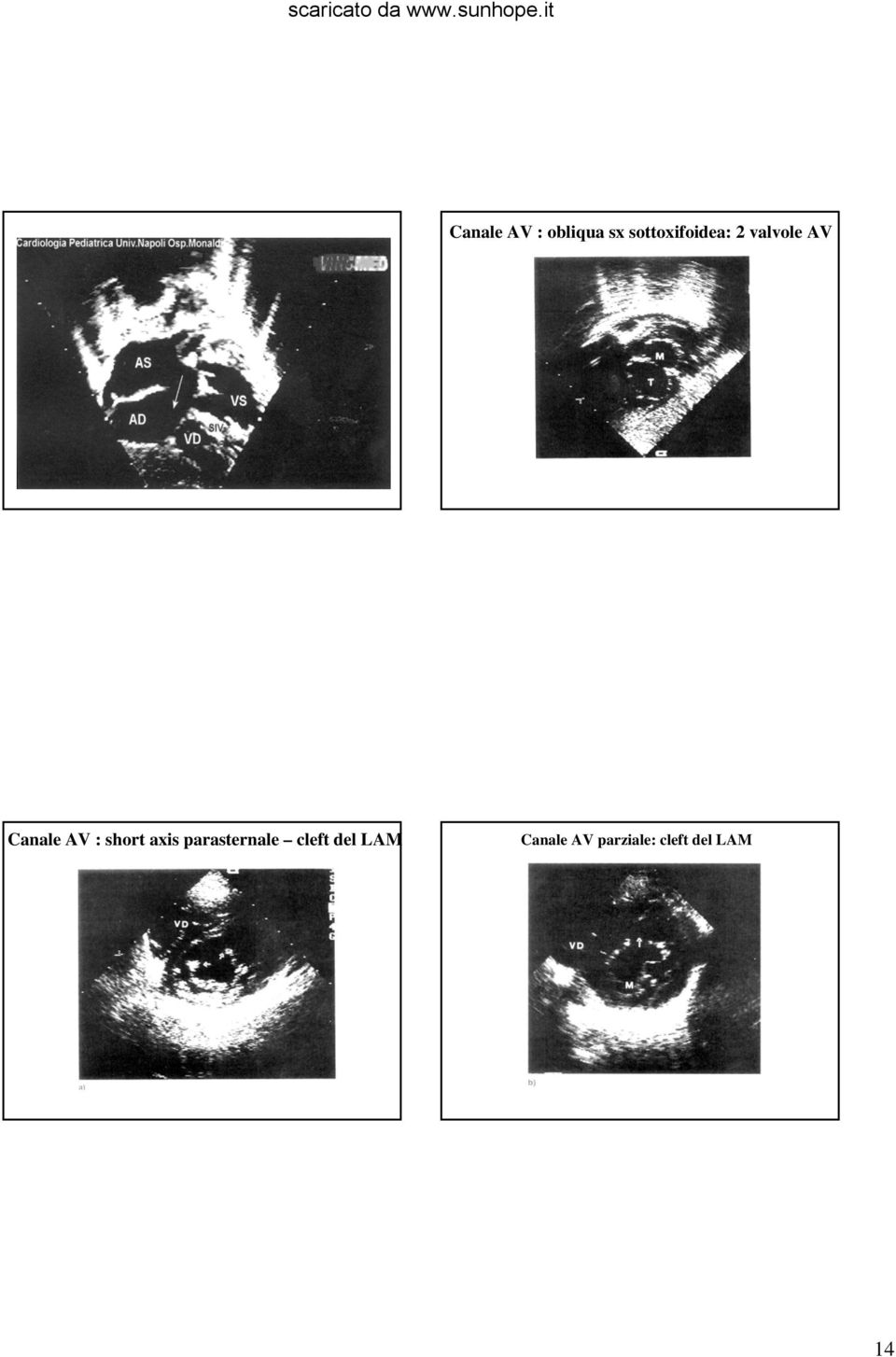 AV : short axis parasternale cleft