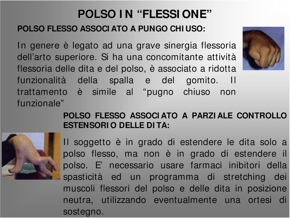 Il trattamento è simile al pugno chiuso non funzionale POLSO FLESSO ASSOCIATO A PARZIALE CONTROLLO ESTENSORIO DELLE DITA: Il soggetto è in grado di estendere le dita solo