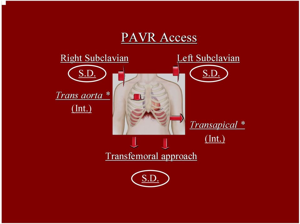 ) Transfemoral approach S.D.