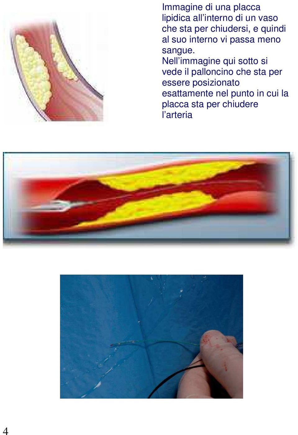 Nell immagine qui sotto si vede il palloncino che sta per essere