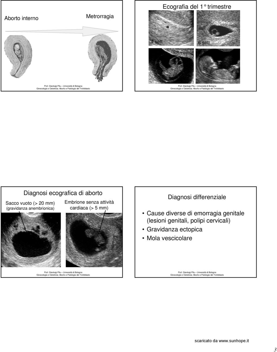 Embrione senza attività cardiaca (> 5 mm) Diagnosi differenziale Cause diverse di