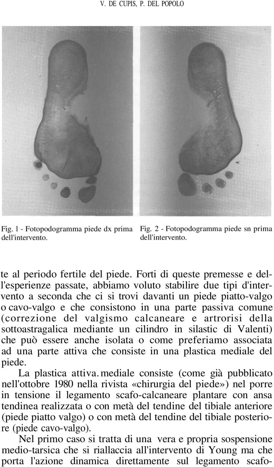 passiva comune (correzione del valgismo calcaneare e artrorisi della sottoastragalica mediante un cilindro in silastic di Valenti) che può essere anche isolata o come preferiamo associata ad una