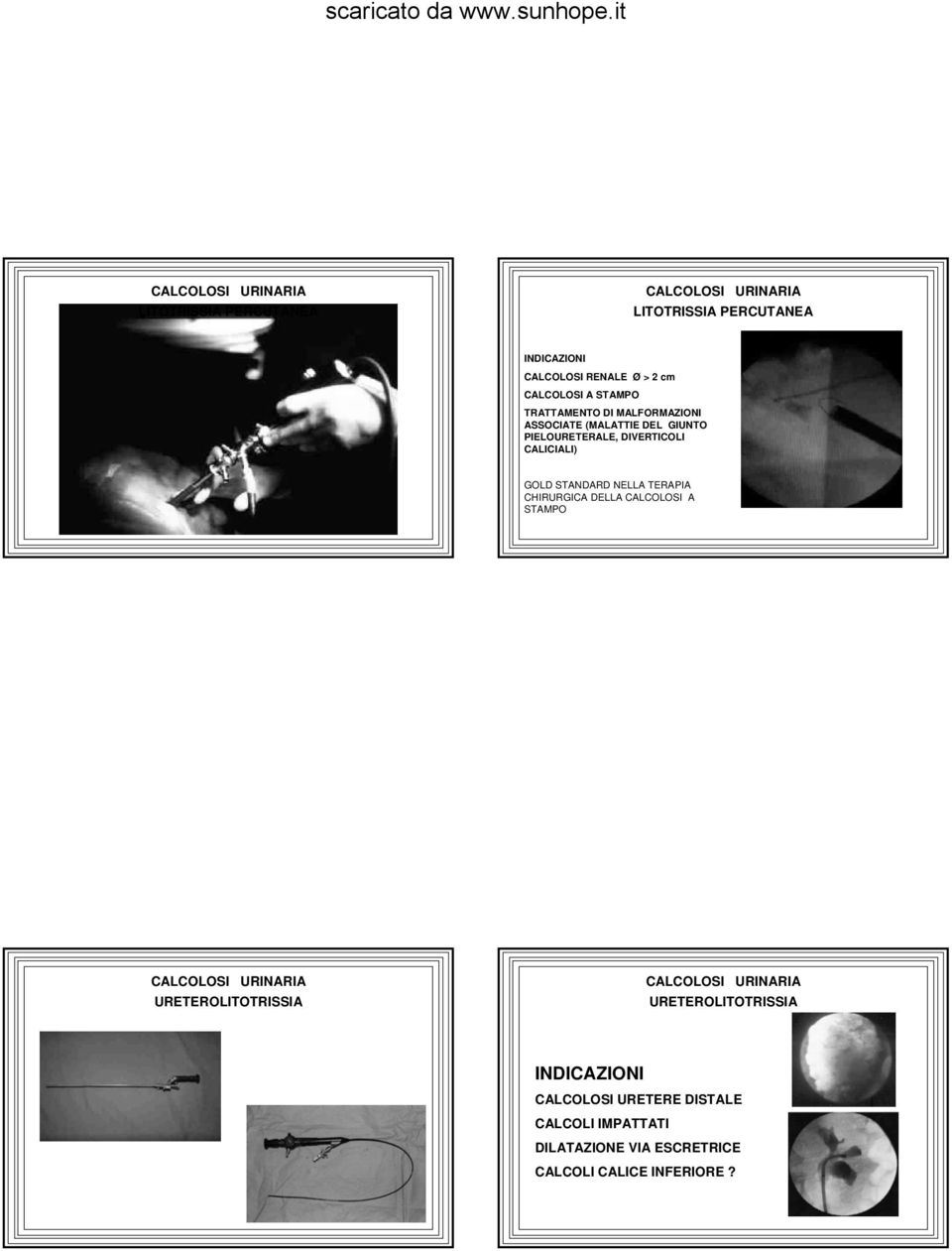 GOLD STANDARD NELLA TERAPIA CHIRURGICA DELLA CALCOLOSI A STAMPO URETEROLITOTRISSIA URETEROLITOTRISSIA